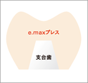 e.maxステイニング（インレー・クラウン）