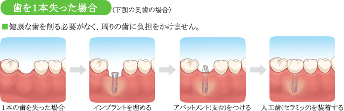 インプラント埋入の流れ