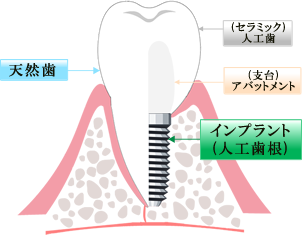 インプラントの仕組み