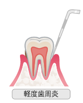 軽度歯周炎