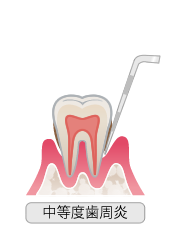 中等度歯周炎