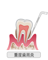 重度歯周炎