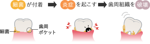 細菌が付着→炎症を起こす→歯周組織を破壊